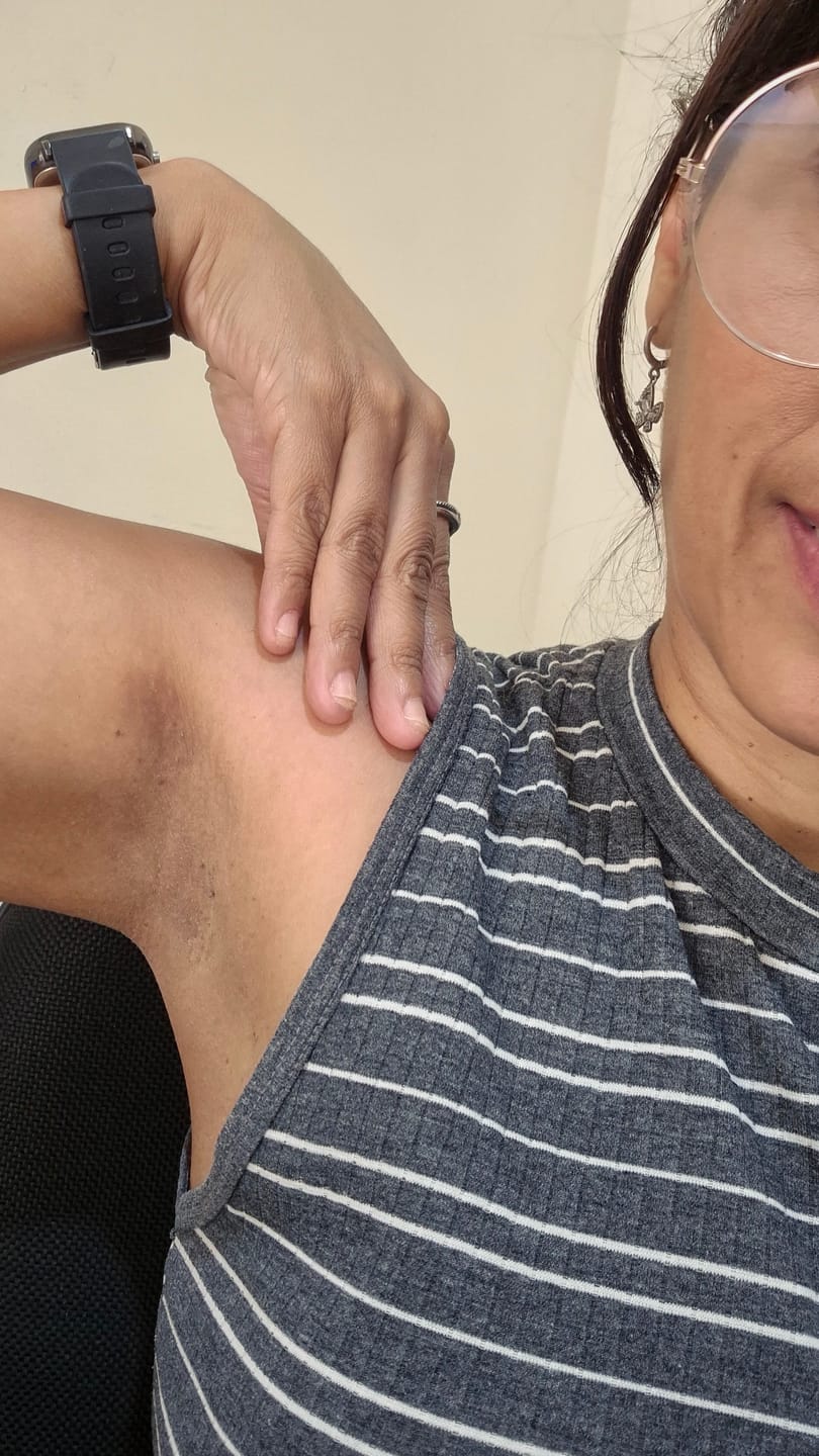 Customer photo review of Creme Clareador de Manchas – Melasma, Axilas, Virilha, Áreas Íntimas, Rosto e Corpo